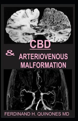 CBD & Arteriovenous Malformation: All You Need To Know About Using CBD Oil for Treating ARTERIOVENOUS MALFORMATION