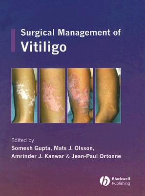 Surgical Management of Vitiligo