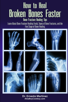 How to Heal Broken Bones Faster. Bone Fracture Healing Tips: Learn About Bone Fracture Healing Foods, Types of Bone Fractures, and the Five Stages of Bone Healing