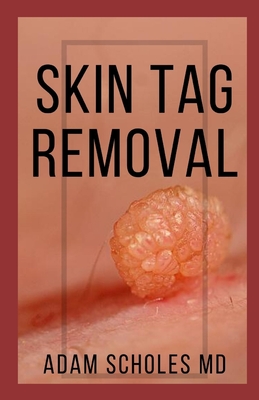 Skin Tag Removal: All You Need To Know About Methods of removing Mole, Wart and Skin Tag Naturally