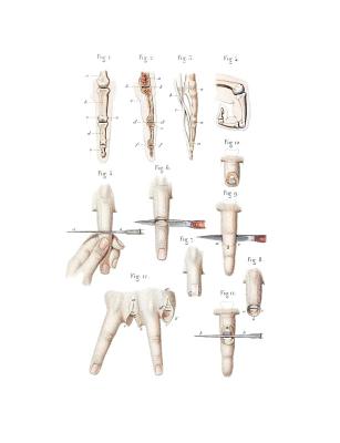 Disarticulation of Phalanges and Finger Composition Notebook: Wide Ruled Note-Taking Book