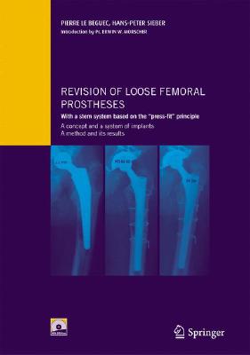Revision of Loose Femoral Prostheses with a Stem System Based on the press-Fit Principle: A Concept and Its System of Implants, a Method and Its Results