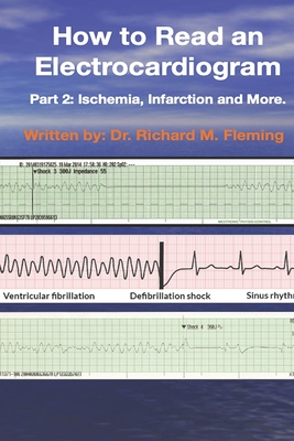 How to Read an Electrocardiogram: Part 2: Ischemia, Infarction and More.