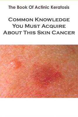 The Book Of Actinic Keratosis_ Common Knowledge You Must Acquire About This Skin Cancer: Skin Cancer Natural Treatment Book