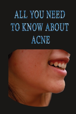 All you need to know about acne: causes and treatments of acne stages solutions natural remedies
